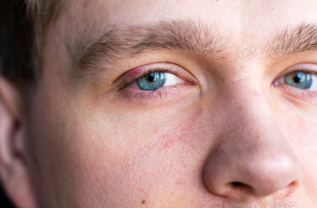 A close-up image of a man's face with a stye present on his left eyelid