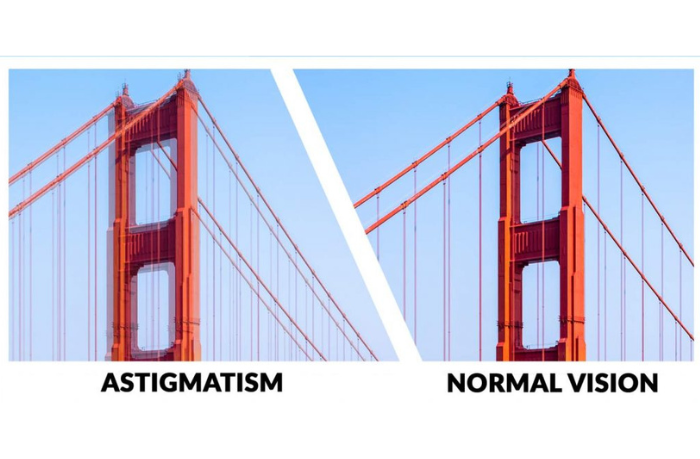 Comparison of the Golden Gate Bridge when you have astigmatism versus normal vision