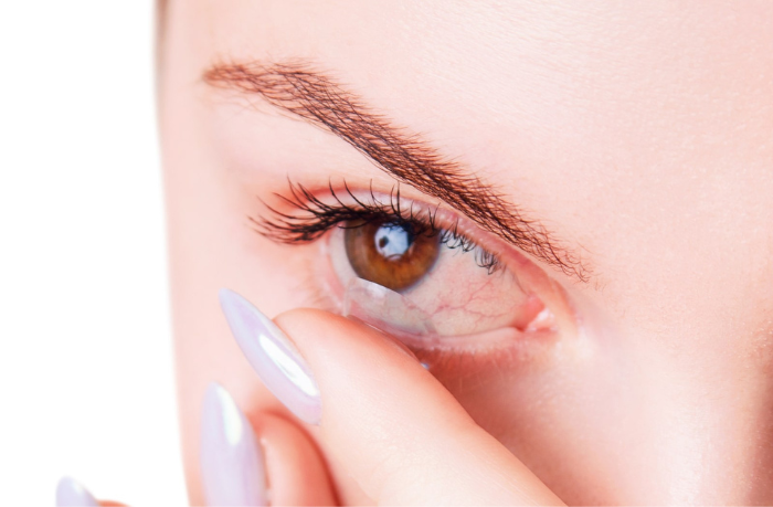 A woman with dry eyes placing a contact lens into her eye