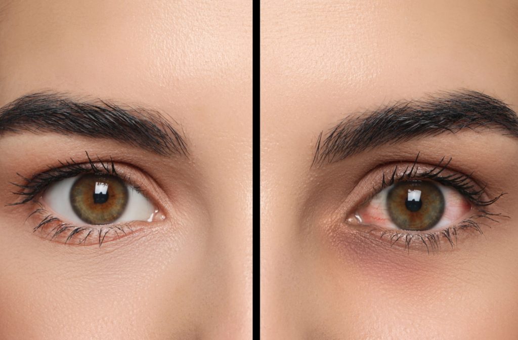 A comparison of a woman's healthy eye and a woman's visibly dry and red eye