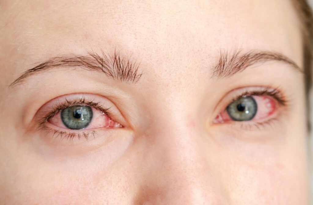 A person's eyes look into the camera they are red and swollen from allergies that are causing them dry eyes in the mornings