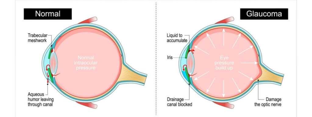 Infographic comparing a healthy eye with an eye affected by glaucoma. The glaucoma-affected eye shows a blocked drainage canal, leading to increased eye pressure and optic nerve damage.