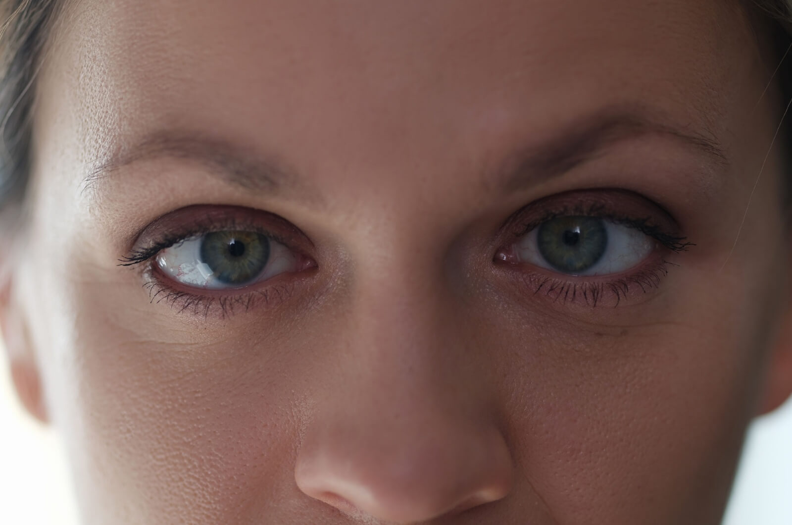 A close up of a young woman staring into the camera with amblyopia.