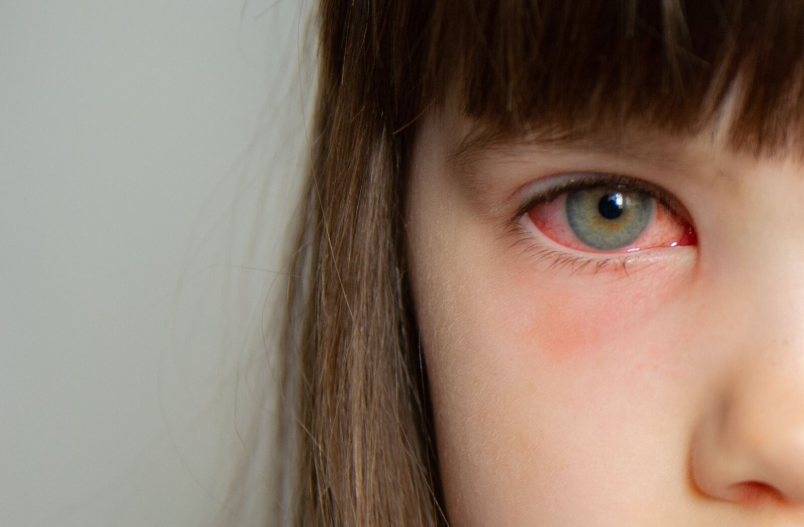 Close-up of a young girl's red, irritated eye.