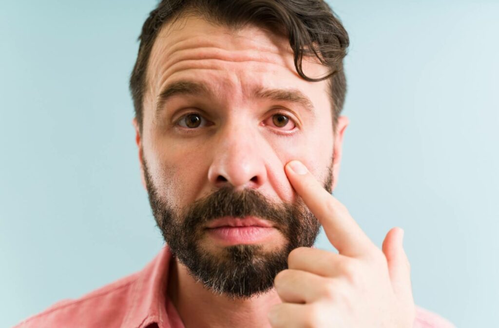 A man with conjunctivitis pulls down on his cheek to expose his red eye to the camera.