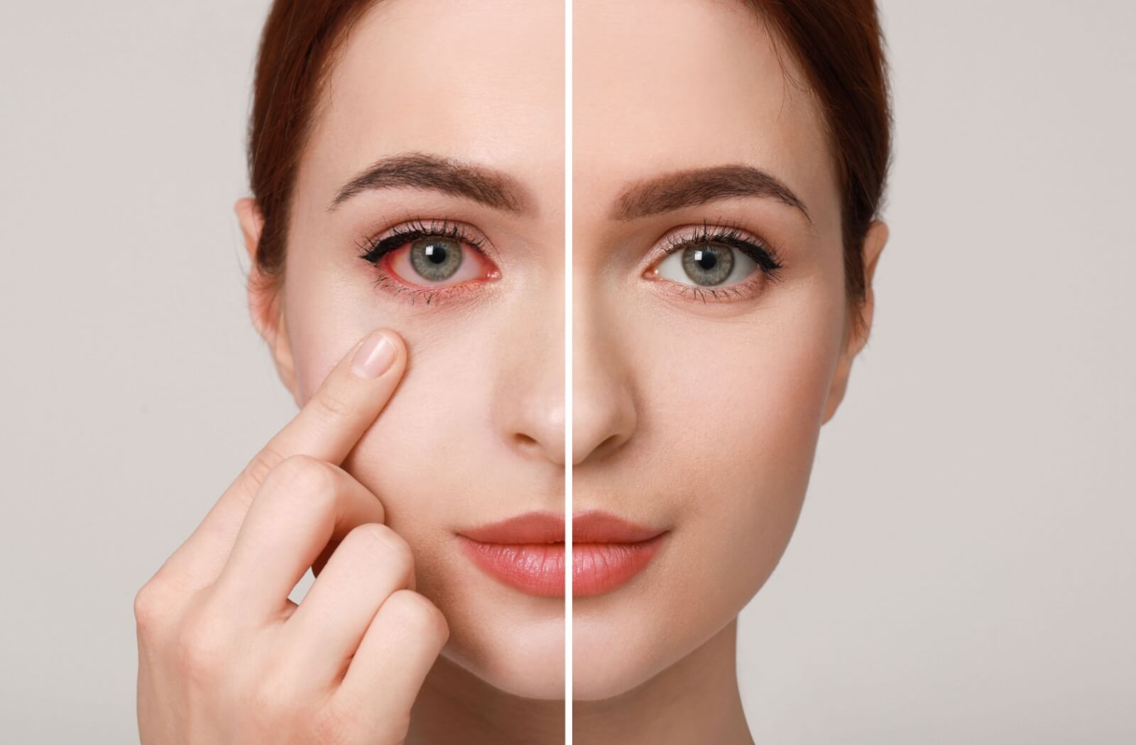 Side-by-side image of a woman with a red, irritated eye on the left and a healthy eye on the right.