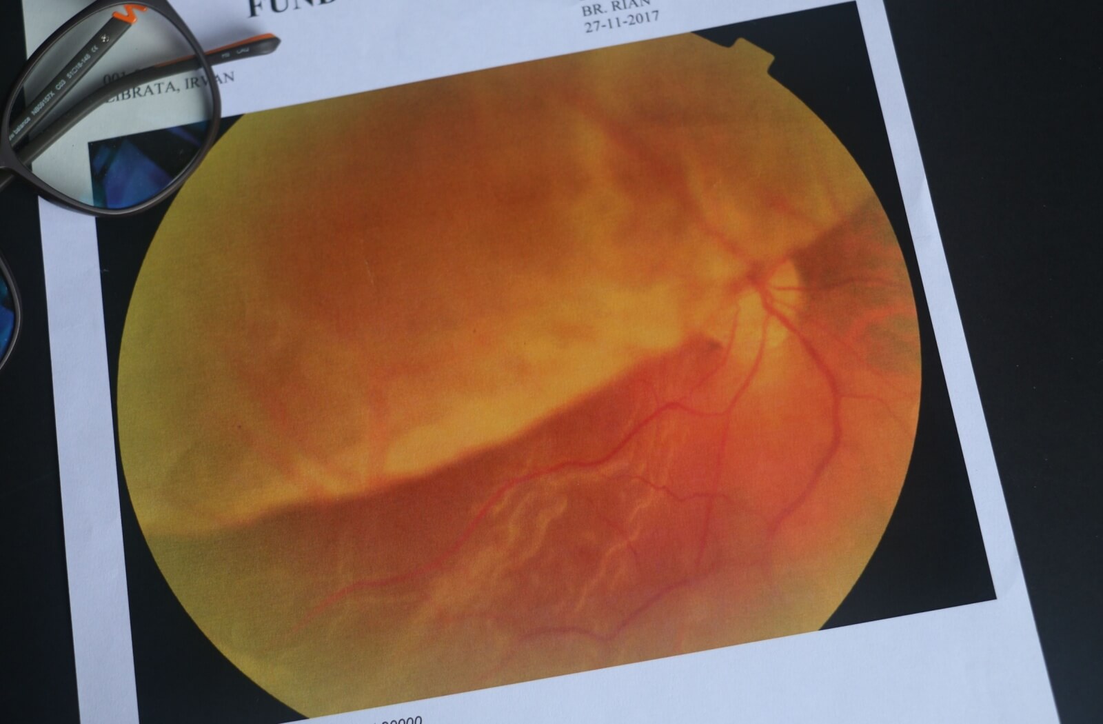 A close-up of a printed retinal scan showing orange and yellow tones with visible blood vessels, placed on a document with a pair of eyeglasses resting nearby.