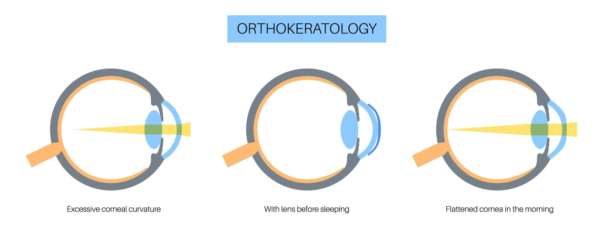 A medical diagram explaining Orthokeratology (Ortho-K), showing how overnight vision correction lenses flatten the cornea to correct excessive curvature.