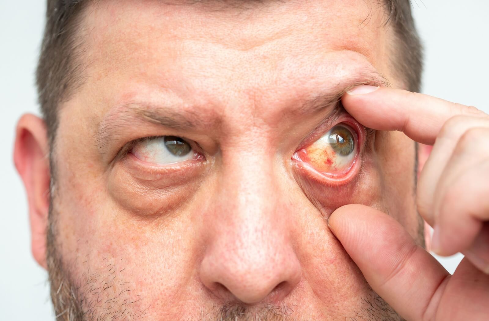 A close-up of a man using his fingers to pull open his eyelid, revealing a bloodshot, red, and inflamed eye.